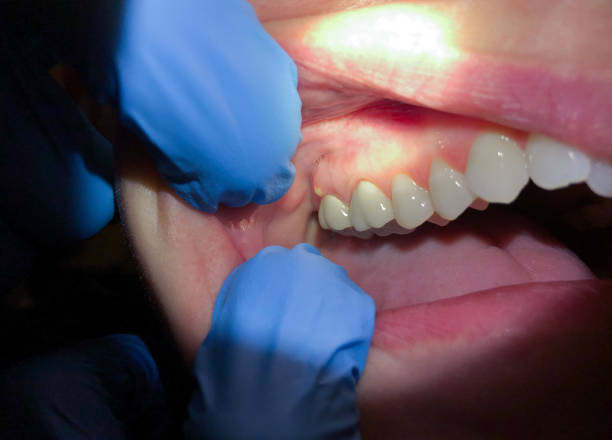 Best Emergency Wisdom Teeth Removal in Ballston Spa, NY